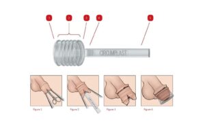 Circumplast® The safest, simplest, and elegant way to perform a circumcision